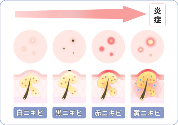 ニキビの種類