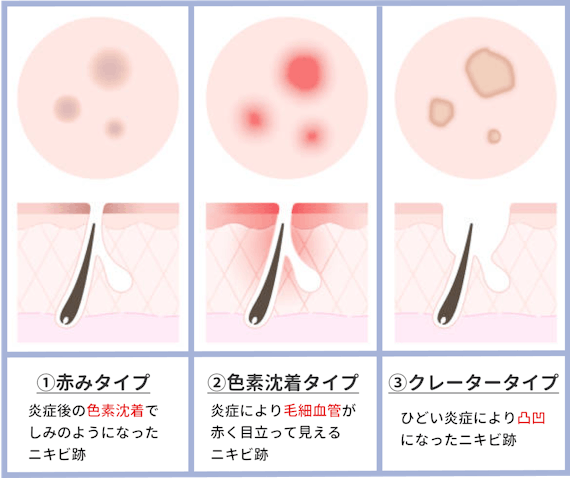 ニキビ跡の種類